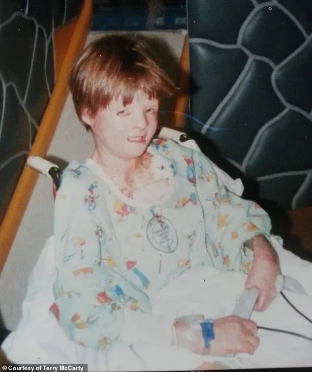 He recalled spending over five hours a day changing his bandages and being covered in scars meant he constantly dealt with stares in public and cruel comments from classmates